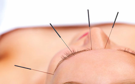 Acupunctura Miofascial - Trigger Points Terapias Leveaqua